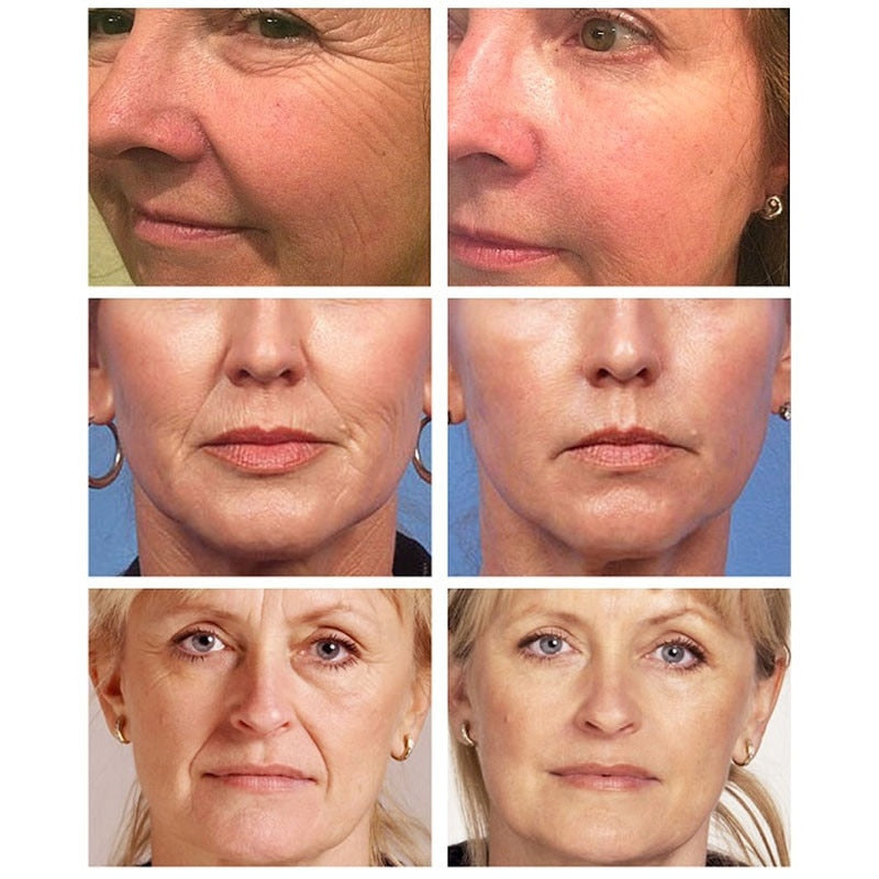 Sérum facial anti envelhecimento com colágeno  - Removedor de rugas